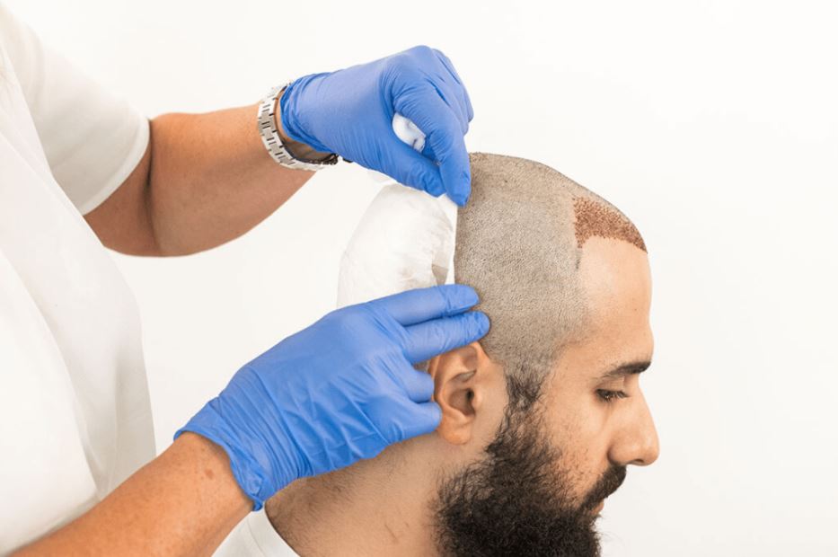 hair transplant